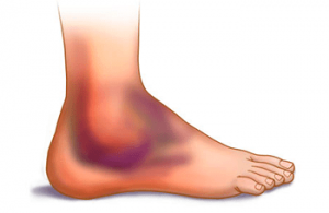 ankle showing bruising and discolouration