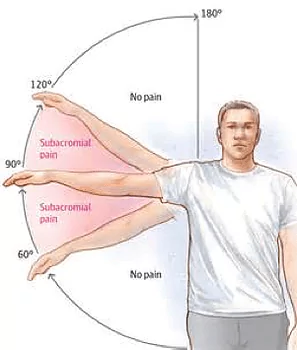 shoulder pain can be tested with the arc movement