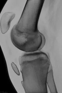 Osgood Schlatter avulsion fracture seen by X-ray