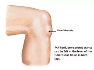 Osgood Schlatter bony protuberance in teens' knee area