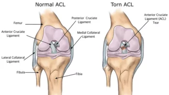 ACL knee injury from hockey