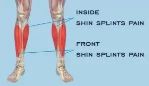 shin splints are hockey injuries