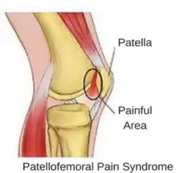 knee pain from PFPS