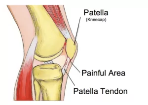 knee pain from PFT