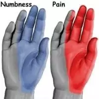 numbness and pain are experienced with carpal tunnel syndrome