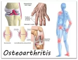 osteoarthritis can be relieved by Physiotherapy