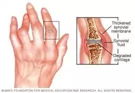 rheumatoid arthritis