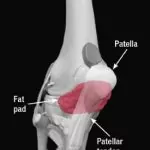 irritation of the fat pad can be helped by physiotherapy