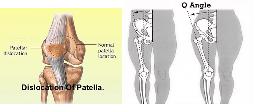 illustration of a kneecap dislocation