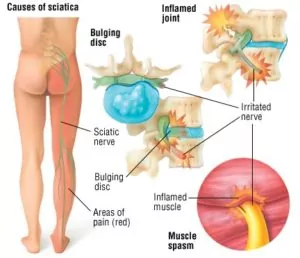 inflammation or compression of nerves cause pain