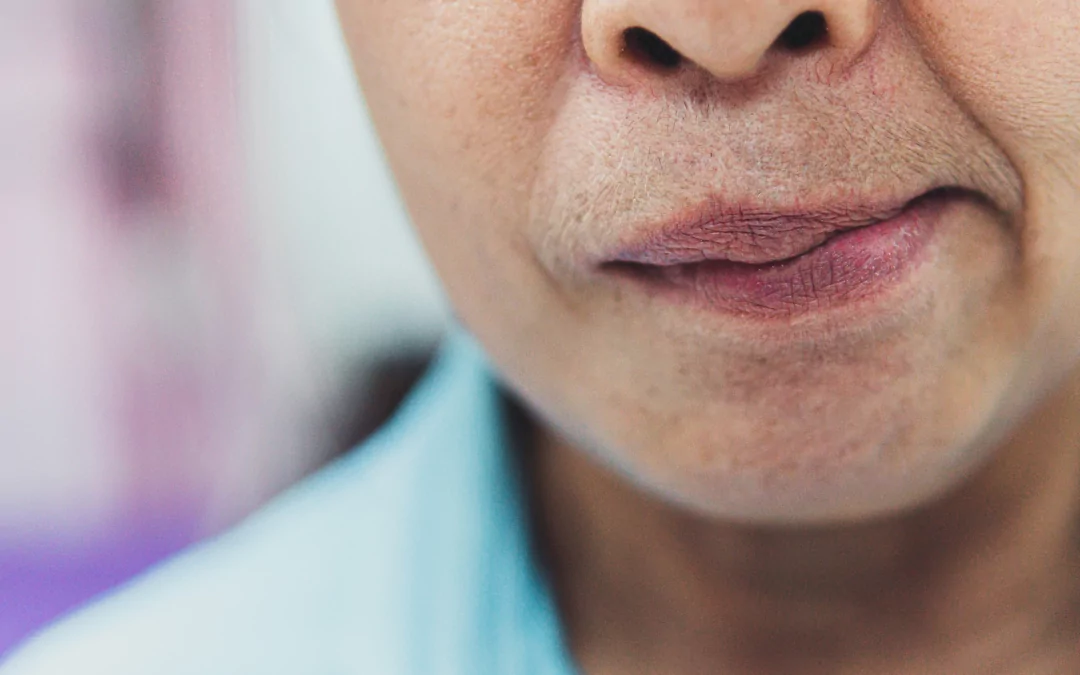 Bell’s Palsy – what you need to know