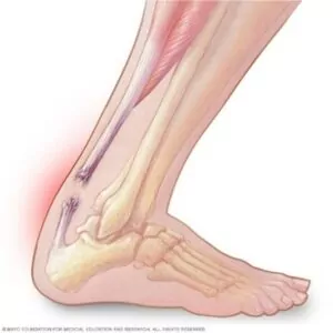 Illustration showing a ruptured achilles tendon