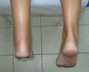 Photo showing ankle with achilles tendon rupture